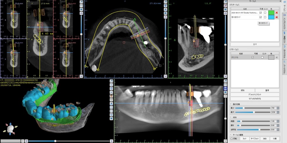 ①無料ソフト、ブルースカイプランでのサージカルガイド＆歯牙レプリカ使い方設計セミナー