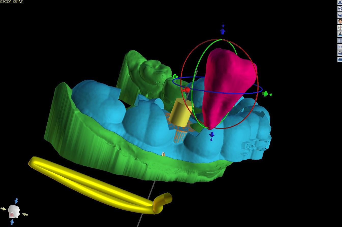 ③NYドリル・オステオトームを用いたフルガイド歯牙移植セミナー