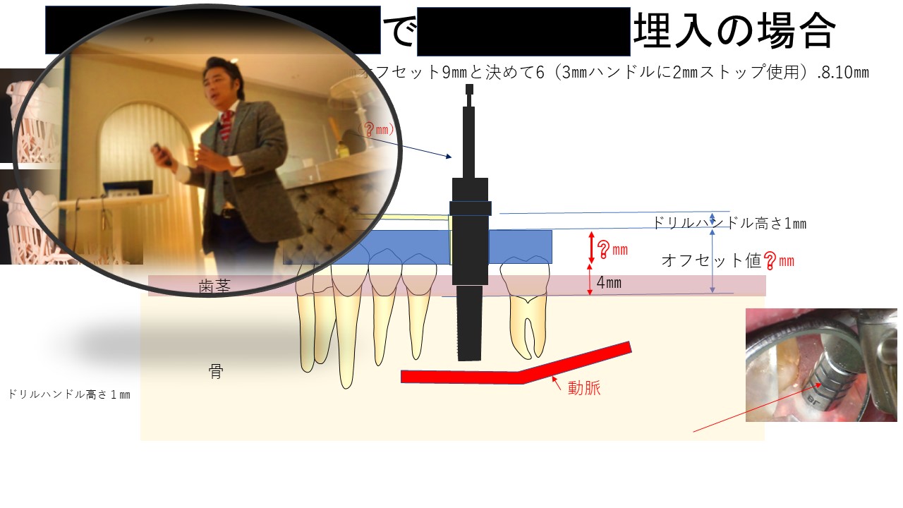 ②サージカルガイドの構成を数値化して応用力を養う＆ガイド用NYオステオトームセミナー